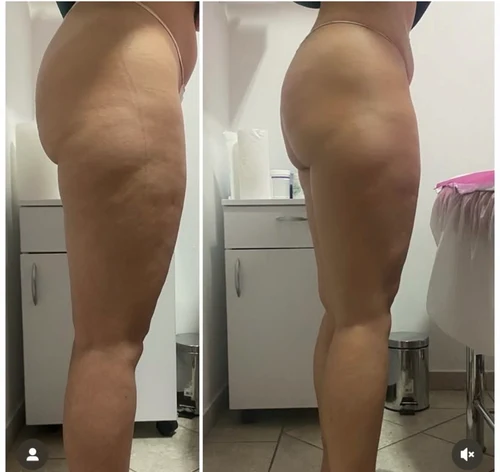 Vacuslim 48 — efekty przed i po, profil